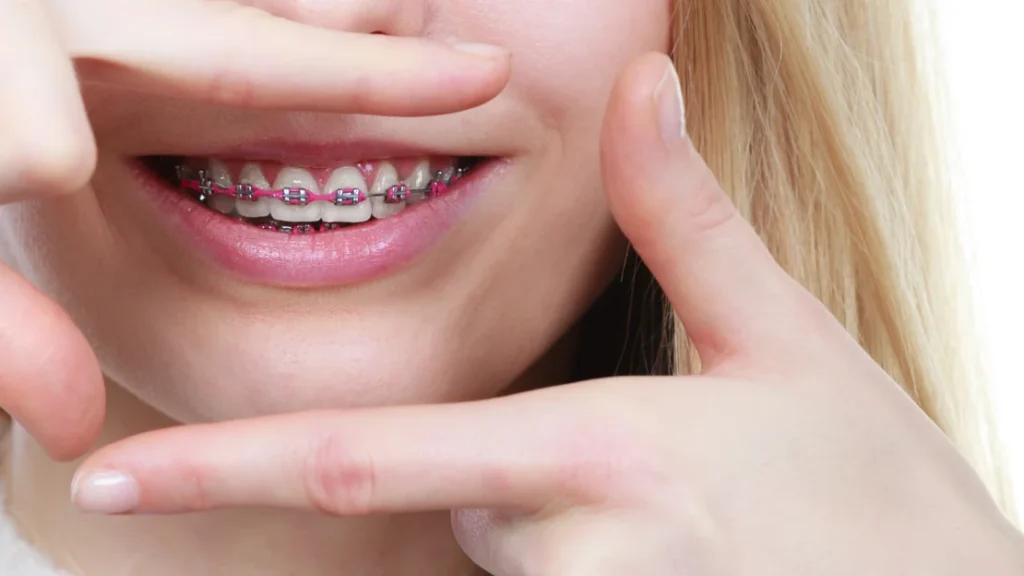 Close-up of a smile with metal braces and pink elastic ties framed by fingers